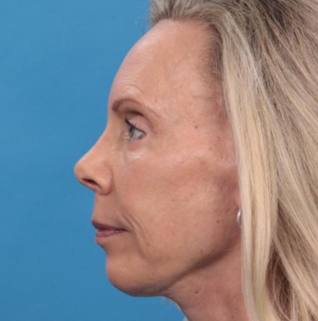 Neck Lift after at JK Plastic Surgery in Frisco, TX