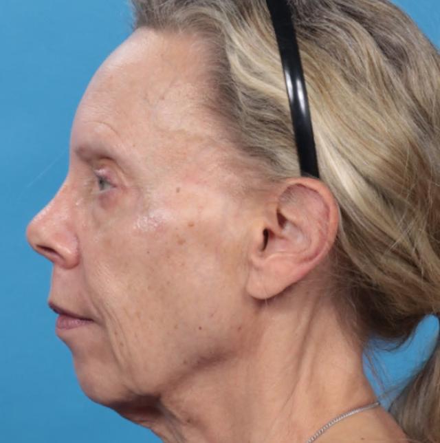 Neck Lift before at JK Plastic Surgery in Frisco, TX