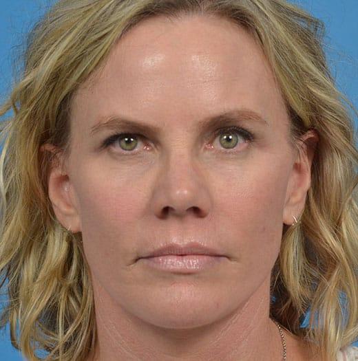 Facelift after at JK Plastic Surgery in Frisco, TX