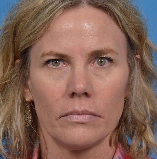 Facelift before at JK Plastic Surgery in Frisco, TX