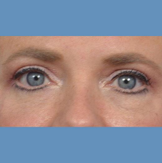 Blepharoplasty after at JK Plastic Surgery in Frisco, TX
