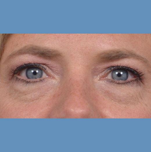Blepharoplasty before at JK Plastic Surgery in Frisco, TX