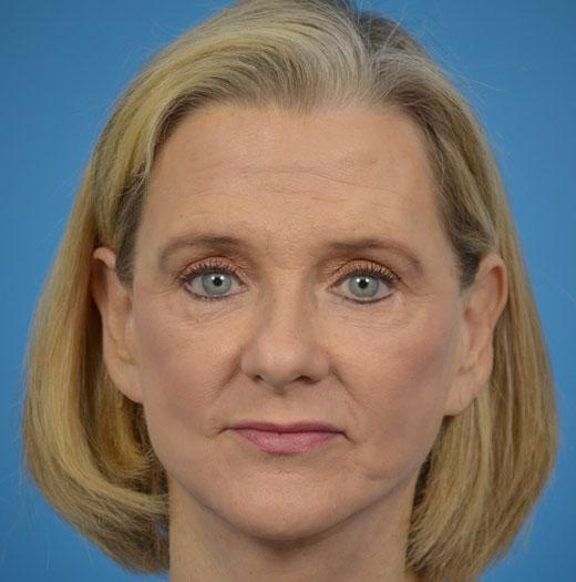 Blepharoplasty after at JK Plastic Surgery in Frisco, TX