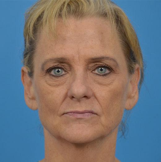 Blepharoplasty before at JK Plastic Surgery in Frisco, TX