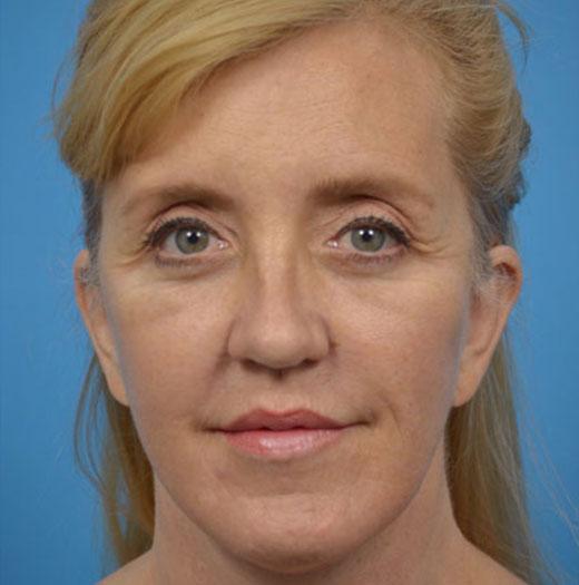 Facelift after at JK Plastic Surgery in Frisco, TX
