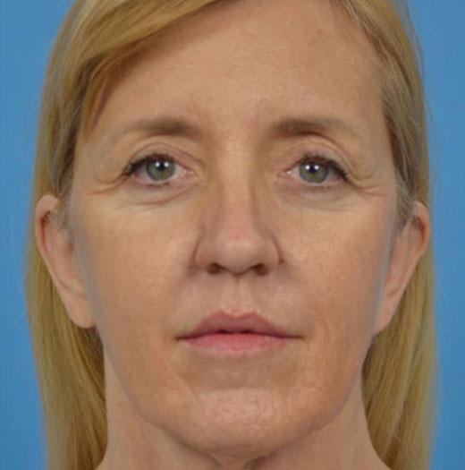 Facelift before at JK Plastic Surgery in Frisco, TX
