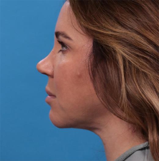 Neck Lift after at JK Plastic Surgery in Frisco, TX