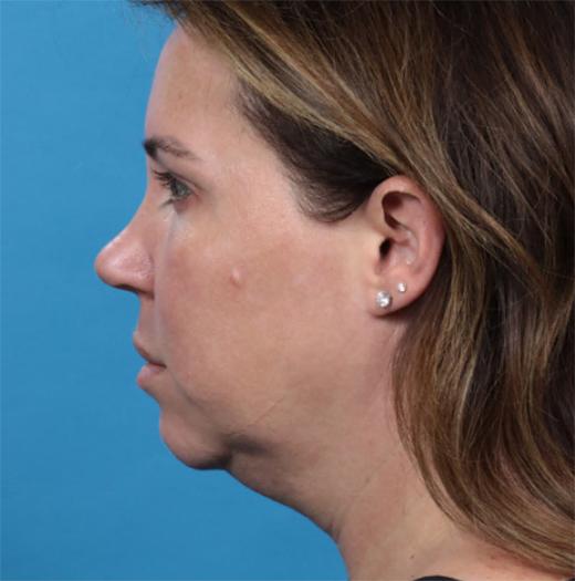 Neck Lift before at JK Plastic Surgery in Frisco, TX