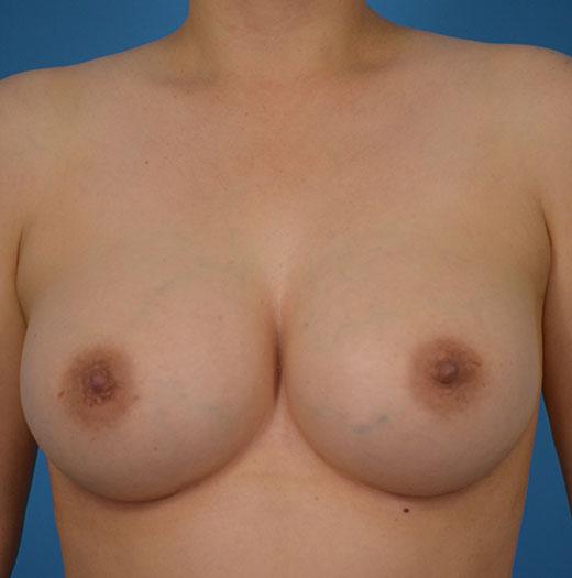 JK Plastic Surgery breast augmentation after — Frisco, TX
