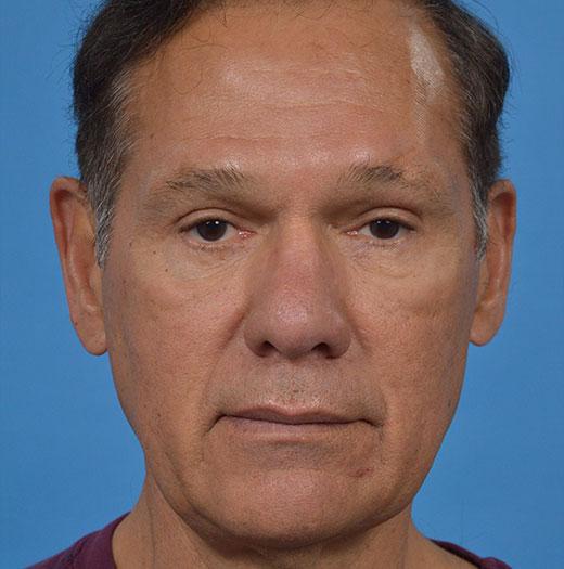 Blepharoplasty after at JK Plastic Surgery in Frisco, TX