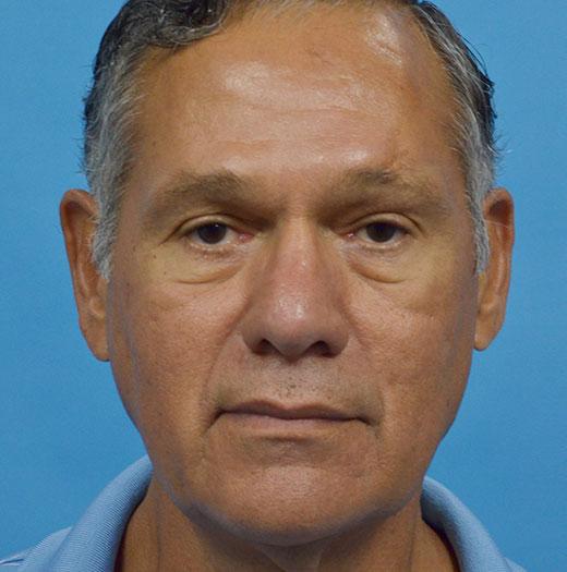 Blepharoplasty before at JK Plastic Surgery in Frisco, TX
