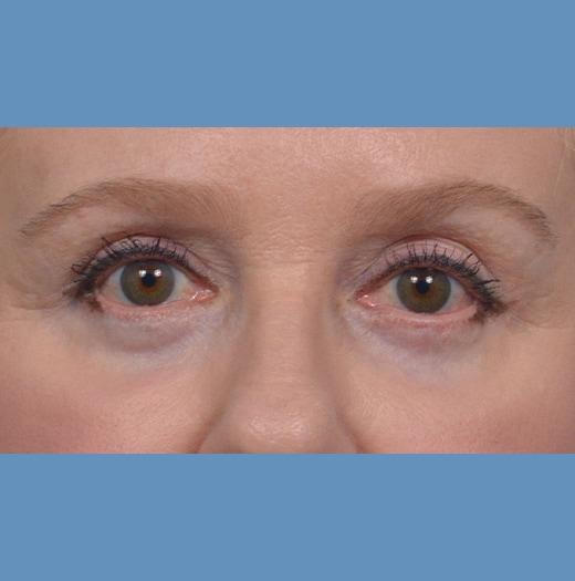 Blepharoplasty after at JK Plastic Surgery in Frisco, TX