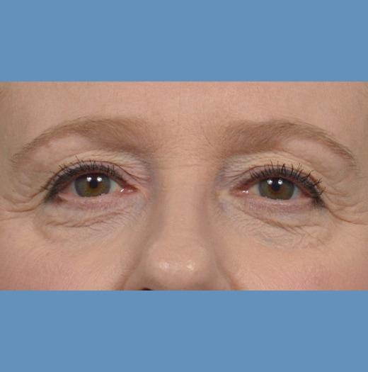 Blepharoplasty before at JK Plastic Surgery in Frisco, TX