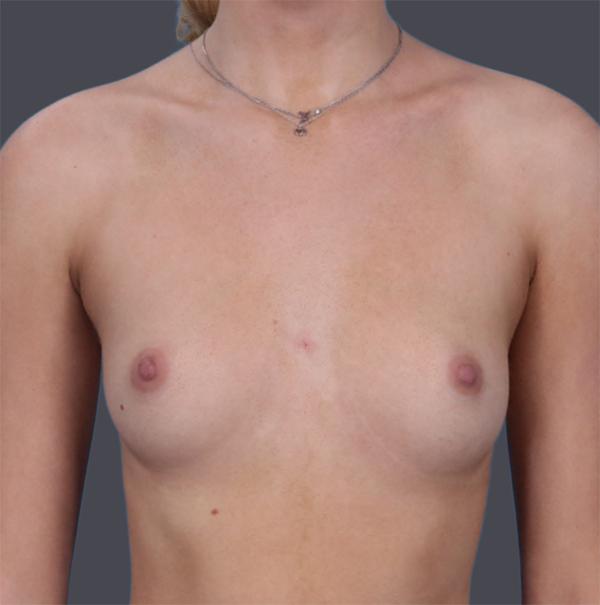 Breast Augmentation before at JK Plastic Surgery in Frisco, TX