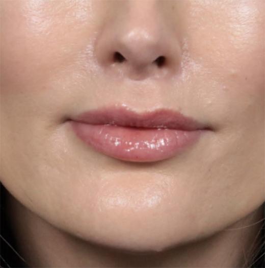 Jawline Filler after at JK Plastic Surgery in Frisco, TX