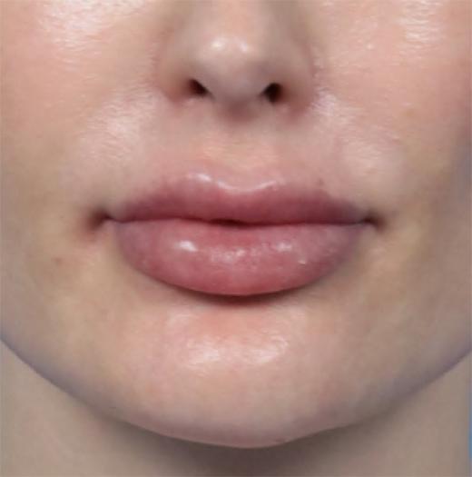 Jawline Filler before at JK Plastic Surgery in Frisco, TX