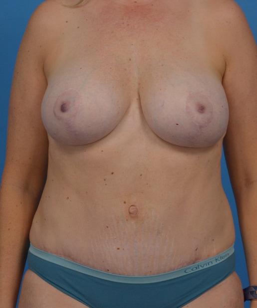 JK Plastic Surgery mommy makeover after — Frisco, TX