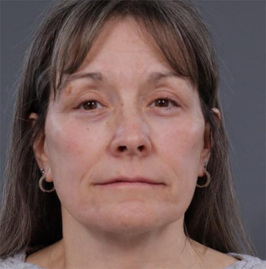 Neck Lift after at JK Plastic Surgery in Frisco, TX