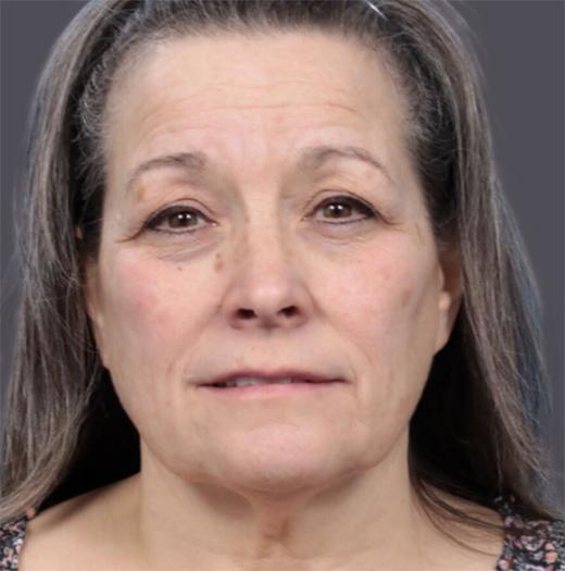 Neck Lift before at JK Plastic Surgery in Frisco, TX