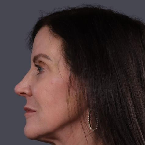 Revision Rhinoplasty after at JK Plastic Surgery in Frisco, TX