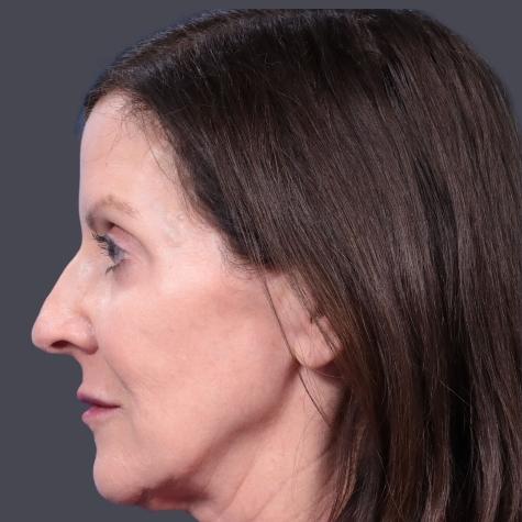 Revision Rhinoplasty before at JK Plastic Surgery in Frisco, TX