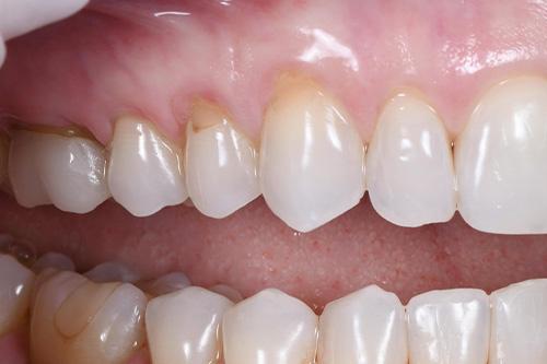 Atlanta Dental Spa veneers after — Atlanta, GA