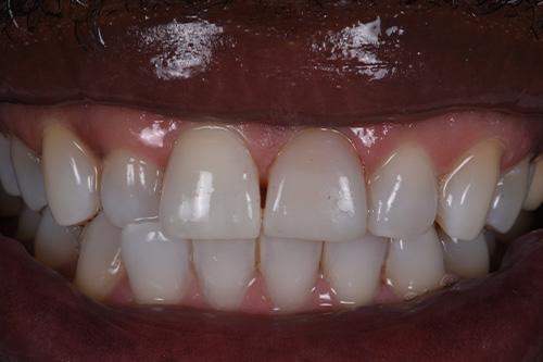 Atlanta Dental Spa veneers after — Atlanta, GA