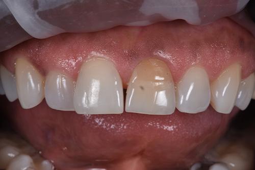 Dental Veneers before at Atlanta Dental Spa in Atlanta, GA
