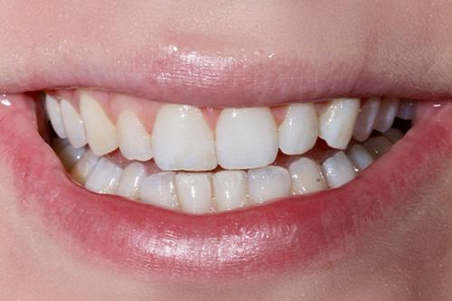 Atlanta Dental Spa veneers after — Atlanta, GA