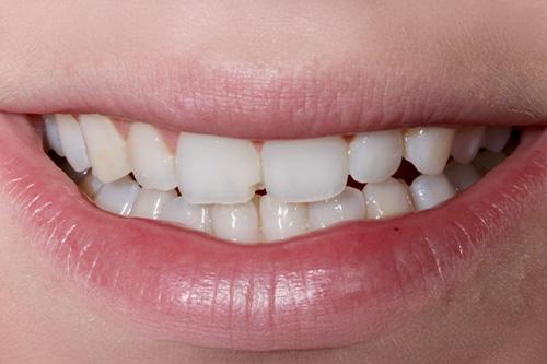 Dental Veneers before at Atlanta Dental Spa in Atlanta, GA