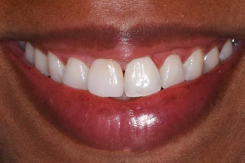 Atlanta Dental Spa veneers after — Atlanta, GA