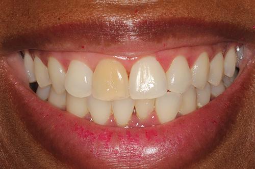 Dental Veneers before at Atlanta Dental Spa in Atlanta, GA