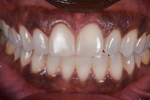 Atlanta Dental Spa veneers after — Atlanta, GA