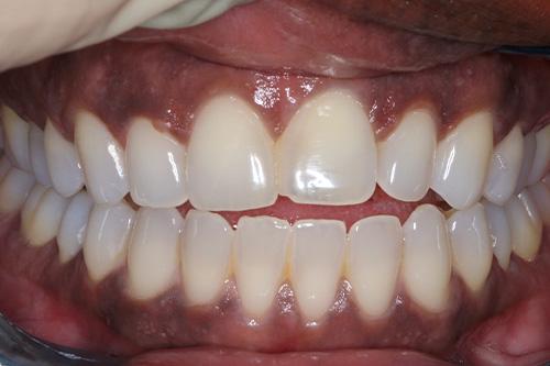 Dental Veneers before at Atlanta Dental Spa in Atlanta, GA