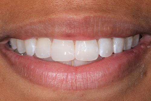 Atlanta Dental Spa veneers after — Atlanta, GA