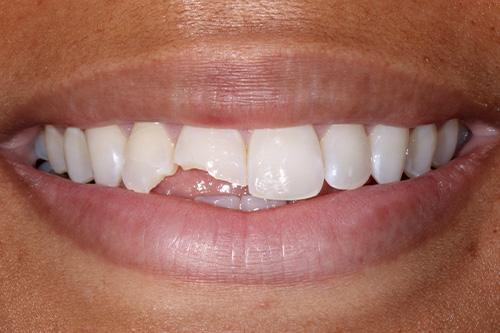 Dental Veneers before at Atlanta Dental Spa in Atlanta, GA