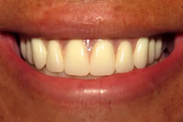 Dental Crowns after at Atlanta Dental Spa in Atlanta, GA