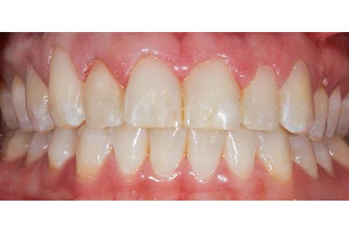 Atlanta Dental Spa veneers after — Atlanta, GA