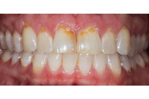 Dental Veneers before at Atlanta Dental Spa in Atlanta, GA
