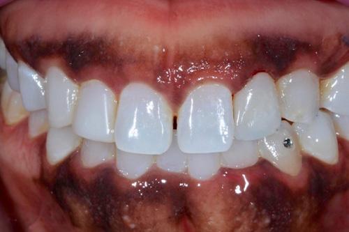 Atlanta Dental Spa veneers after — Atlanta, GA