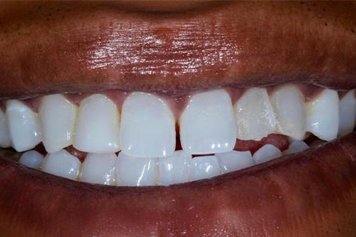 Dental Veneers before at Atlanta Dental Spa in Atlanta, GA