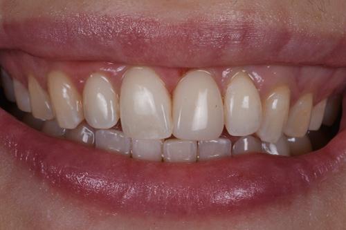 Atlanta Dental Spa veneers after — Atlanta, GA