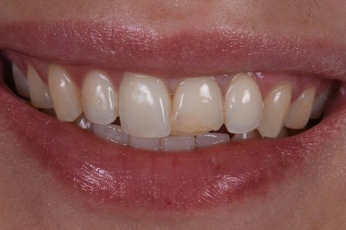 Dental Veneers before at Atlanta Dental Spa in Atlanta, GA
