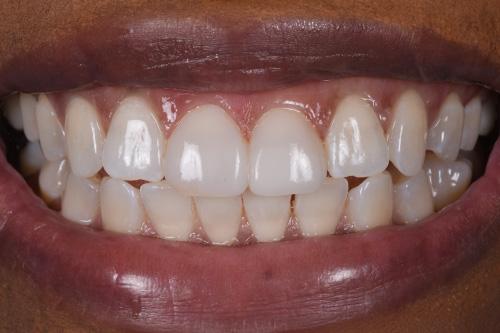 Atlanta Dental Spa veneers after — Atlanta, GA