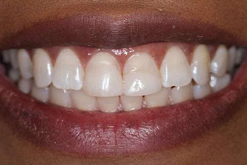 Dental Veneers before at Atlanta Dental Spa in Atlanta, GA