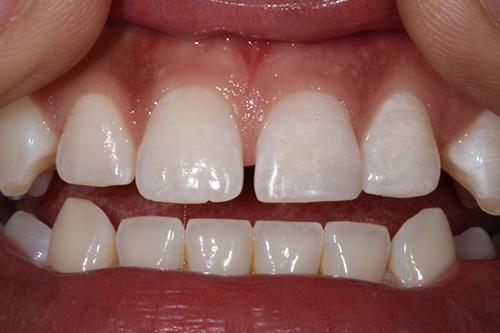 Atlanta Dental Spa veneers after — Atlanta, GA