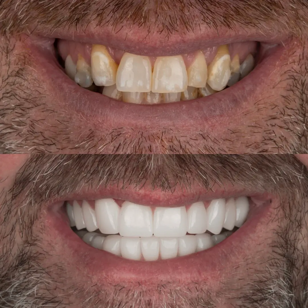 Cherry Creek Restorative Dentistry veneers result — Denver, CO