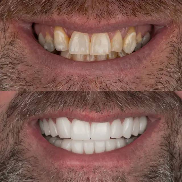 Invisalign result at Cherry Creek Restorative Dentistry in Denver, CO