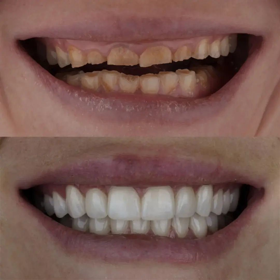 Cherry Creek Restorative Dentistry veneers result — Denver, CO