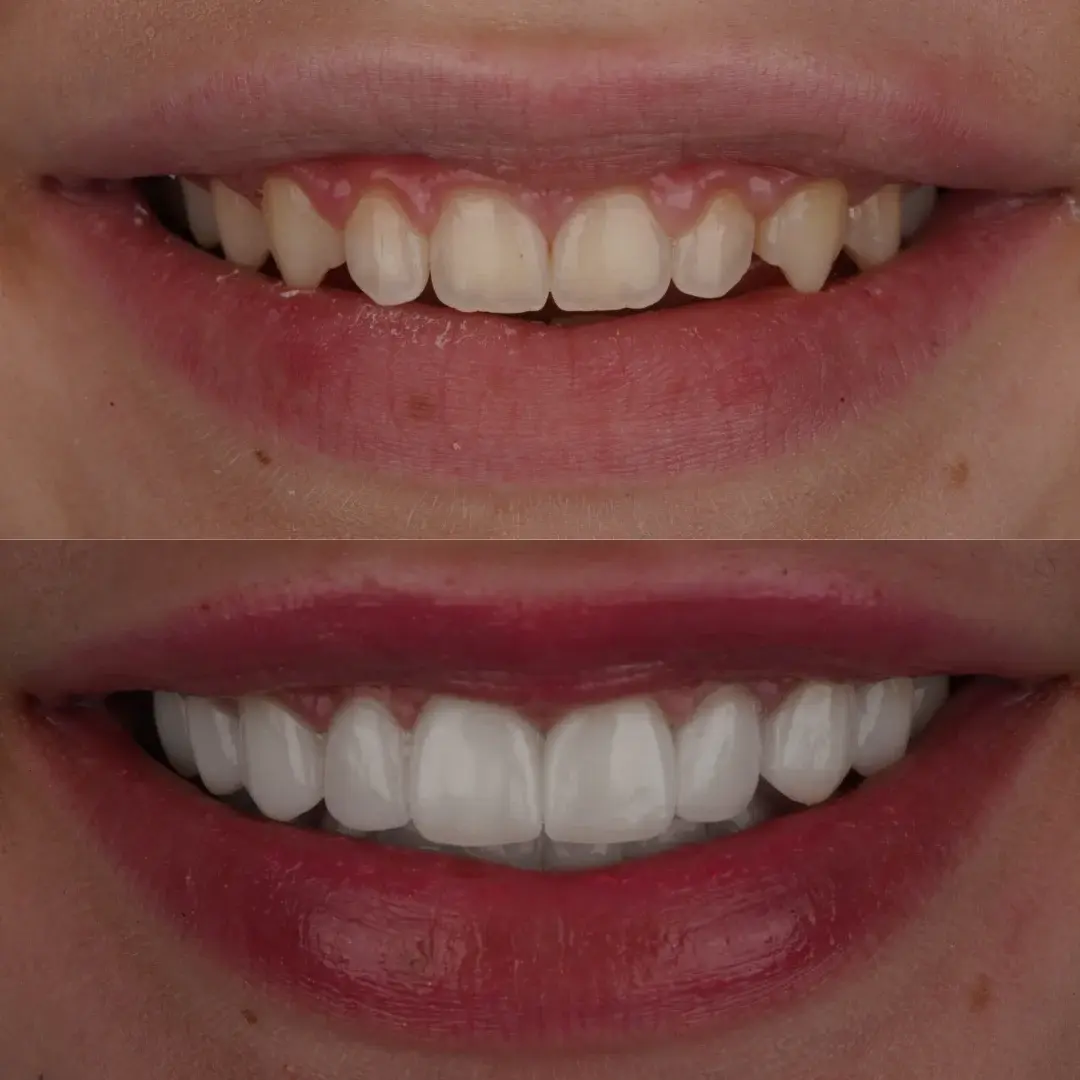 Cherry Creek Restorative Dentistry veneers result — Denver, CO